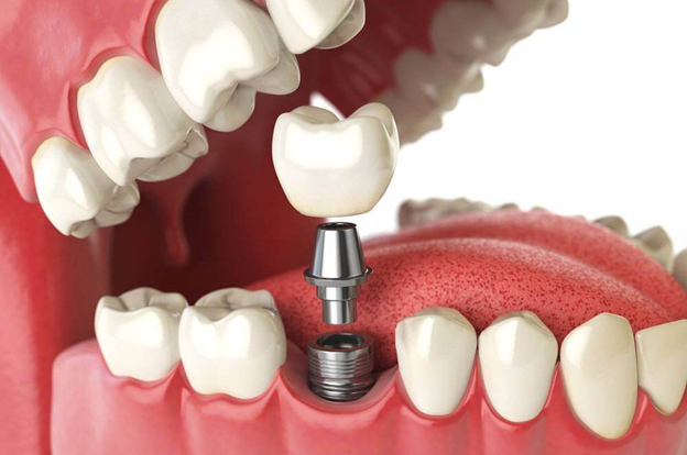 Как выбрать опытного стоматолога для установки имплантов: руководство по выбору